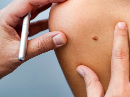 С чего начинается родинка: как распознать опасность