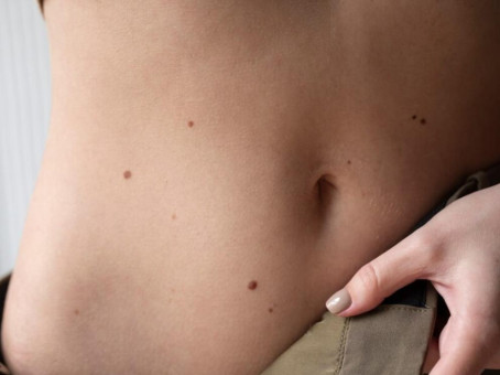 Родинки на теле могут много рассказать о вашей личности