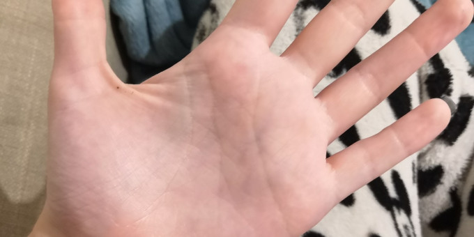 Женщина с черной точкой на руке — что это значит на самом деле