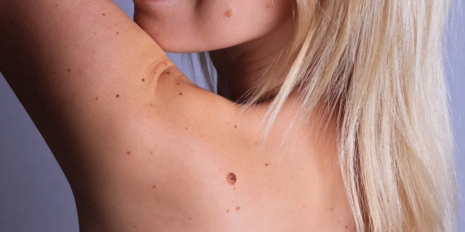 5 признаков того, что ваши родинки надо срочно показать врачу