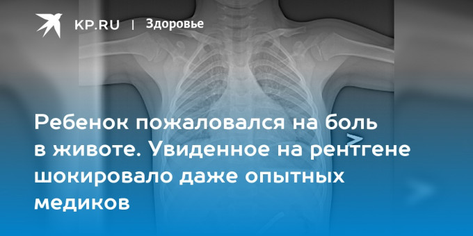 Ребенок пожаловался на боль в животе. Увиденное на рентгене шокировало даже опытных медиков